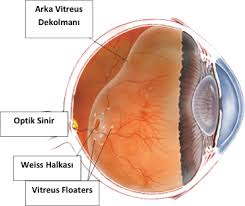 Arka Vitreus Dekolmani Avd Prof Dr Ziya Kapran