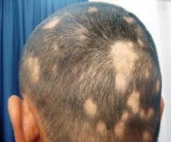 Hair loss may also be caused by several drugs and medications. ØªÙØ³ÙŠØ± Ø­Ù„Ù… Ù…Ø±Ø¶ Ø§Ù„Ø«Ø¹Ù„Ø¨Ù‡ ÙÙŠ Ø§Ù„Ù…Ù†Ø§Ù…