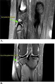 Anatomy of the knee can be complicated and hard to understand. Role Of Magnetic Resonance Imaging In The Evaluation Of The Popliteus Musclotendinous Injuries As A Part Of The Posterolateral Corner Injuries Of The Knee Sciencedirect
