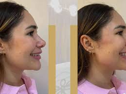 Ex-BBB se recupera de danos severos na pele e mostra nova aparência