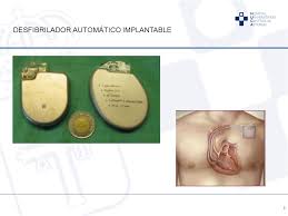 Ante arritmias potencialmente mortales está indicado el desfibrilador automático implantable que hace de forma automática emite un choque revirtiendo las arritmias mortales en ritmo sinusal si estas. Que Hace El Desfibrilador Automatico Implantable