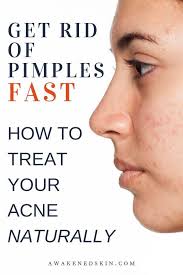 Haut sauber zu halten ist immer wichtig, aber wenn sie akne haben, ist es sogar noch mehr. How To Zap Pimples Fast 8 Proven Natural Acne Treatments How To Get Rid Of Pimples Back Acne Treatment Pimples