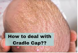 Image result for Cradle Cap