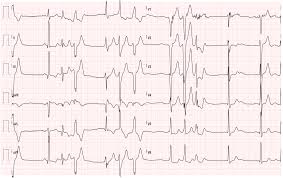 La miocardite è un'infiammazione del muscolo cardiaco in genere associata a infezioni virali, batteriche o fungine rx del torace. Http Web2 Sacrocuore It Oncologia Negrar 25 26 Gennaio 2019 Sinagra Pdf