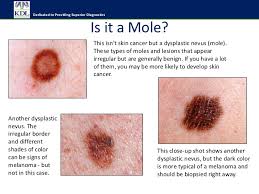 I've had this happen a lot of times in the beard area for men, garner said. Do I Have Skin Cancer
