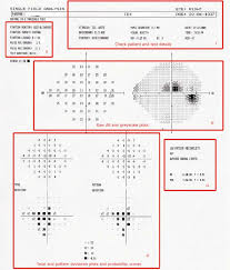 Interpreting Visual Field Vf Test Result Each Box