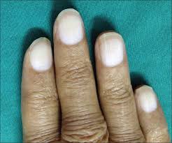 Terry's nails - Indian Journal of Nephrology