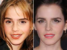 Emma Watson Before and After - The Skincare Edit
