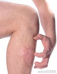 Scabies can be controlled with a pill or two, and the protective effect lasts for years, scientists reported on wednesday. What Are The Pros And Cons Of Using Ivermectin For Scabies