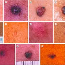 These indicators let you know if a visit to your doctor might be a good idea. Skin Cancer Price Skin Care
