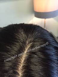 It's usually available in a liquid or foam formula that's massaged directly into the scalp. Natural Scalp Appearance On A Wig Natural Looking Thinning Hair Solutions Wigs Hair Piec Help Hair Loss Natural Hair Loss Treatment Hair Loss Natural Remedy