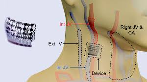 Wearable Ultrasound Patch Monitors Blood Pressure Nih Director S Blog