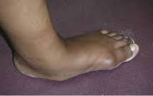 How do you use club foot in a sentence? Out Toeing Children S Orthopaedic And Scoliosis Surgery Associates Llp