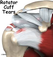 At the shoulder, the two tendons both attach to the large flat bone in the upper trunk called the scapula. Rotator Cuff Tears Orthogate