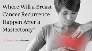 Brca1 and brca2 are examples of genes that raise your cancer risk if they become altered. Where Will A Breast Cancer Recurrence Happen After A Mastectomy Youtube