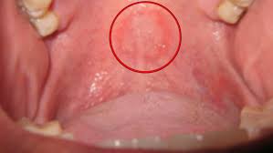 Sexo: Lesión por felación: el insólito descubrimiento en la consulta del  dentista