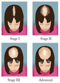 What's your hair loss stage? Female Pattern Baldness Healthdirect
