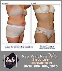 Look At Our Amazing Before And After Aqua Sculpting Liposuction Below Get Your Body Sculpted Beautiful Liposuction Procedure Liposuction Cosmetic Surgery