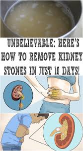 Unbelievable Here S How To Remove Kidney Stones In Just 10 Days Healthy Advice Natural Health Tips Kidney Cleanse Natural