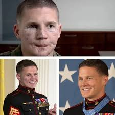 Medal Of Honor recipient Kyle Carpenter before and after facial  reconstruction surgery.