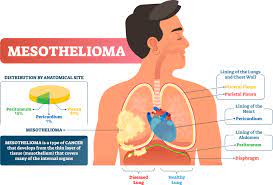 At cancer treatment centers of america ® (ctca), we target mesothelioma with a variety of therapies, including surgery, chemotherapy, radiation therapy, immunotherapy and targeted therapy. Effects Of Asbestos Exposure Sheilds Health And Safety Blog