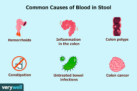 Image result for Blood in stool