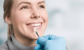 Enhance Your Smile with e.max Veneers: The Ultimate Guide