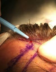 Normally, we would expect all the hair to regrow. Head Trauma Tempus Hair