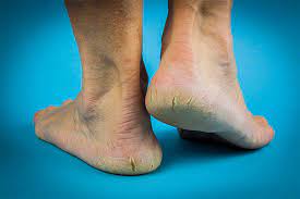 Cracked Peeling Feet Triad Foot Ankle Center