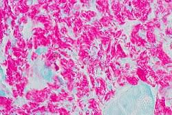 Image result for Extrapulmonary Tuberculosis
