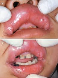 Image result for papillomavirus tongue)