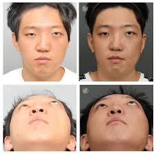 Clinical Application of 3D-Printed Patient-Specific Polycaprolactone/Beta  Tricalcium Phosphate Scaffold for Complex Zygomatico-Maxillary Defects