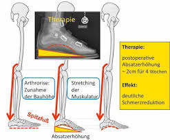 Wenn das längsgewölbe des fußes (die wölbung der fußsohle an der fußinnenseite vor dem vorfußballen) abgeflacht ist, wird dies als senkfuß bezeichnet. Die Nachbehandlung Einer Arthrorise Beim Knicksenkfuss Orthopadie Technik