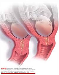 the short cervix and preterm birth 8 key questions and