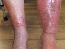 The area usually looks red, but this may be less obvious on brown or black cellulitis is usually caused by a bacterial infection. Cellulitis Mimics Dermnet Nz