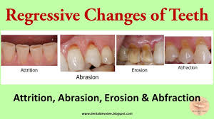 Image result for Tooth Abrasion