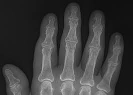 Image result for XRay Changes in Rheumatic Conditions