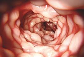 De volgende symptomen komen vaak voor bij patiënten met de ziekte van crohn Ibd S Alle Hulp Is Welkom Pharma Sphere
