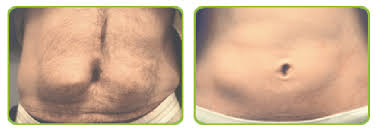 We did not find results for: A Abdominal Picture Of Lipohypertrophic Patient B Abdominal Picture Download Scientific Diagram