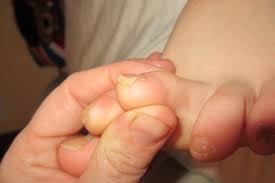 toenails curling into toes netmums