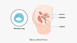 Image result for Pessary