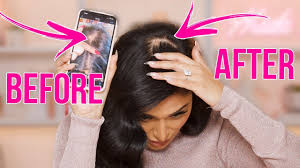 Then read here about how to get rid of hair bumps with natural techniques. How To Get Rid Of Bald Spots I Tried It On Myself Ø§Ù„Ø¨Ù‚Ø¹Ø© Ø§Ù„ØµÙ„Ø¹Ø§Ø¡ Ø³Ø¨Ø¨Ù‡Ø§ ÙˆÙƒÙŠÙ Ø¹Ø§Ù„Ø¬ØªÙ‡Ø§ Youtube