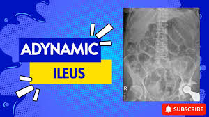 Image result for Adynamic Ileus