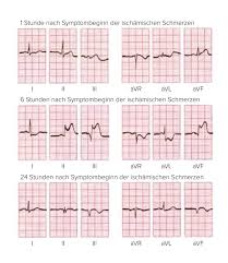 Zwei von drei herzinfarkten werden von einem ekg überhaupt nicht oder nicht rechtzeitig erkannt. Herzinfarkt Deximed