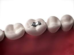 But there are certain factors than can accelerate the formation of a cavity. Dental Fillings Austin Tx
