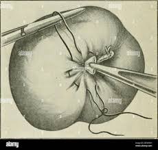 Image result for Purse String Suture