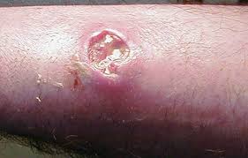 skin lesions pictures causes types risks diagnosis and