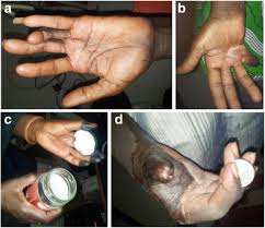 Sepsis sepsis is an infection of the bloodstream that leads to a widespread inflammatory response. Patterns Of Finger Sepsis And Predictors Of Its Outcome In Patients With Diabetic Septic Hand Springerlink