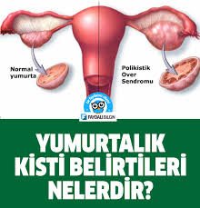 Yumurtalik Kisti Belirtileri Nelerdir Saglik Yumurtalik Kisti Saglik Guzellik Ipuclari