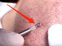 This requires careful preparation of the skin before every. Video Man Extracts Ingrown Hair That Looks Like Blackhead